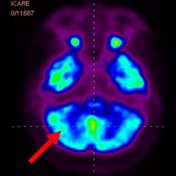 Cell Therapy Fo Autism, Autism Treatment