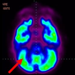 Cell Therapy Fo Autism, Autism Treatment