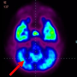 Cell Therapy Fo Autism, Autism Treatment