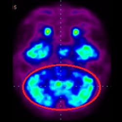 Cell Therapy Fo Autism, Autism Treatment