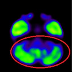 Cell Therapy Fo Autism, Autism Treatment