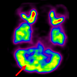 Cell Therapy For Cerebral Palsy, Treatment For Cerebral Palsy