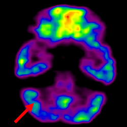 cell therapy For Cerebral Palsy, Treatment For Cerebral Palsy