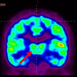 Cell Therapy For Cerebral Palsy, Treatment For Cerebral Palsy