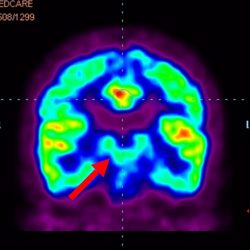 Cell Therapy For Cerebral Palsy, Treatment For Cerebral Palsy