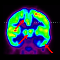 Cell Therapy For Cerebral Palsy, Treatment For Cerebral Palsy