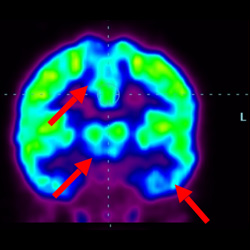 Cell Therapy For Cerebral Palsy, Treatment For Cerebral Palsy