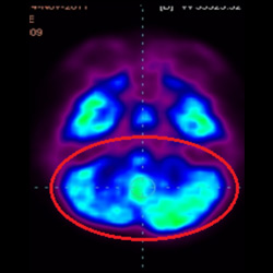 Cell Therapy For Cerebral Palsy, Treatment For Cerebral Palsy