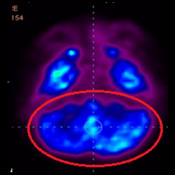 Cell Therapy For Cerebral Palsy, Treatment For Cerebral Palsy