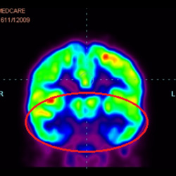 Cell Therapy For Cerebral Palsy, Treatment For Cerebral Palsy