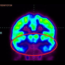 Cell Therapy For Cerebral Palsy, Treatment For Cerebral Palsy