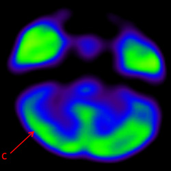 Cell Therapy For Cerebral Palsy, Treatment For Cerebral Palsy