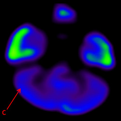 Cell Therapy For Cerebral Palsy, Treatment For Cerebral Palsy