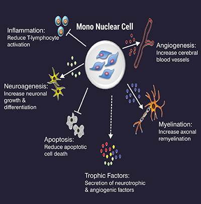 Stem Cell Therpay For Traumatic Brain Injury, Traumatic Brain Injury