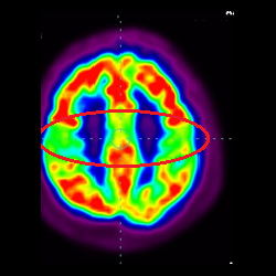 cell therapy For Intellectual Disability, Intellectual Disability