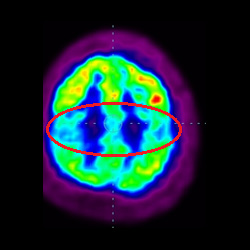 Cell Therapy For Intellectual Disability, Intellectual Disability