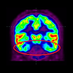 Cell Therapy For Intellectual Disability, Intellectual Disability