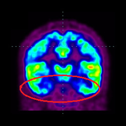 Cell Therapy For Intellectual Disability, Intellectual Disability