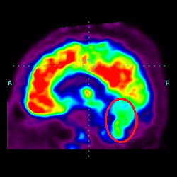 Cell Therapy For Intellectual Disability, Intellectual Disability