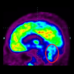 Cell Therapy For Intellectual Disability, Intellectual Disability