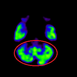 Cell Therapy For Intellectual Disability, Intellectual Disability