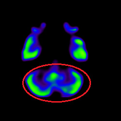 Cell Therapy For Intellectual Disability, Intellectual Disability