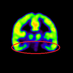 Cell Therapy For Intellectual Disability, Intellectual Disability