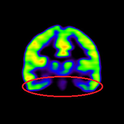 Cell Therapy For Intellectual Disability, Intellectual Disability