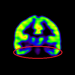 Cell Therapy For Intellectual Disability, Intellectual Disability