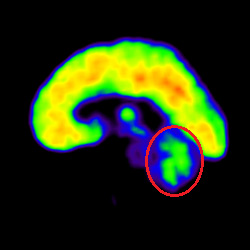 Cell Therapy For Intellectual Disability, Intellectual Disability