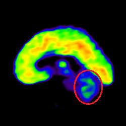 Cell Therapy For Intellectual Disability, Intellectual Disability