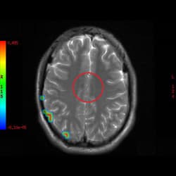 Spinal Cord Injury, cell therapy For Spinal Cord Injury