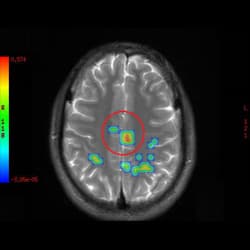 Spinal Cord Injury, cell therapy For Spinal Cord Injury