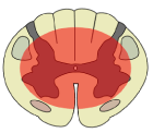 Types of Spinal Cord Injury, Anterior Cord Syndrome