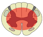 Types of Spinal Cord Injury, Central Cord Syndrome