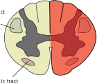 Types of Spinal Cord Injury, Brown Sequard Syndrome