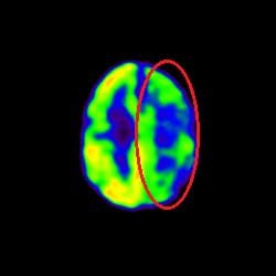 Stroke Treatment, Cell Therapy For Stroke