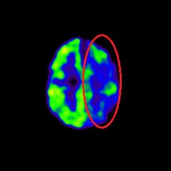 Stroke Treatment, cell therapy For Stroke