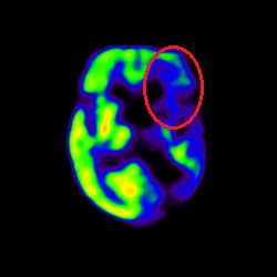 Stroke Treatment, Cell Therapy For Stroke