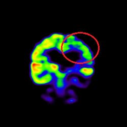 Stroke Treatment, Cell Therapy For Stroke