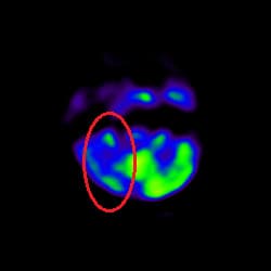 Stroke Treatment, Cell Therapy For Stroke