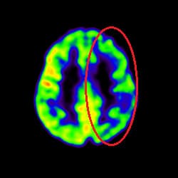 Stroke Treatment, Cell Therapy For Stroke