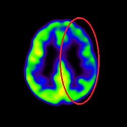 Stroke Treatment, Cell Therapy For Stroke