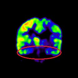 Stroke Treatment, Cell Therapy For Stroke