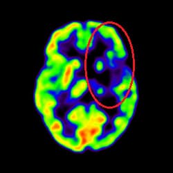 Post Cell Therapy for Stroke