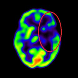 Stroke Treatment, Cell Therapy For Stroke