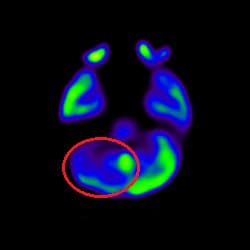 Pre Cell Therapy for Stroke