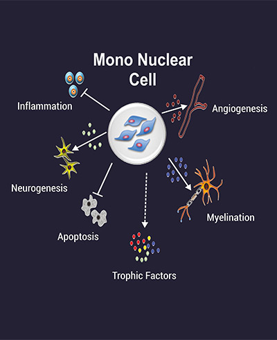 Stroke Treatment, cell therapy For Stroke