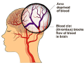 Thrombotic Stroke