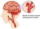 Cerebral Hemorrhage